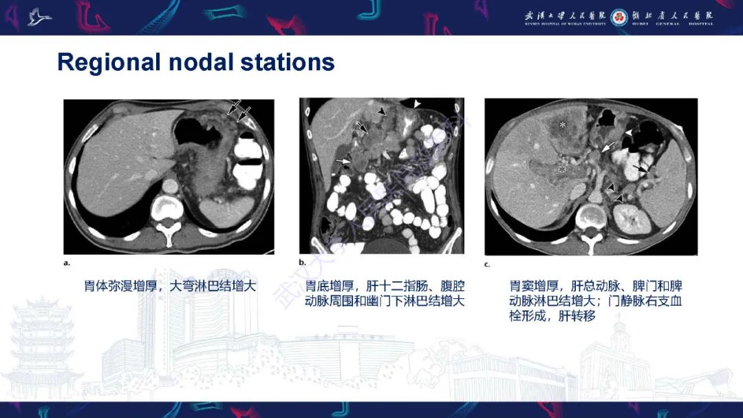 影像PPT - 【PPT】胃癌淋巴引流及TNM分期-34