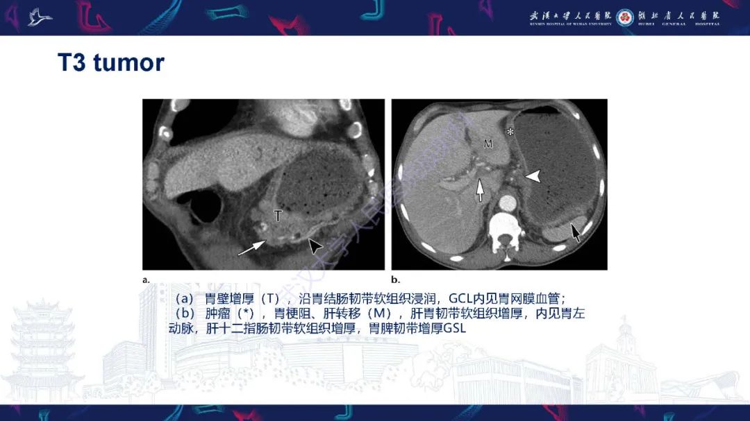 影像PPT - 【PPT】胃癌淋巴引流及TNM分期-37