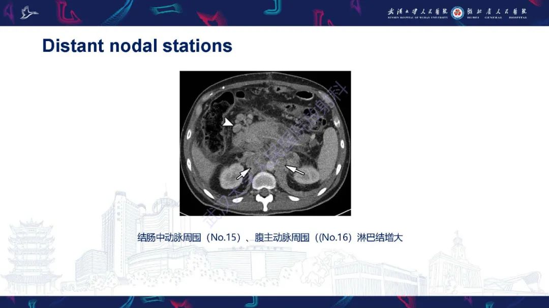 影像PPT - 【PPT】胃癌淋巴引流及TNM分期-35