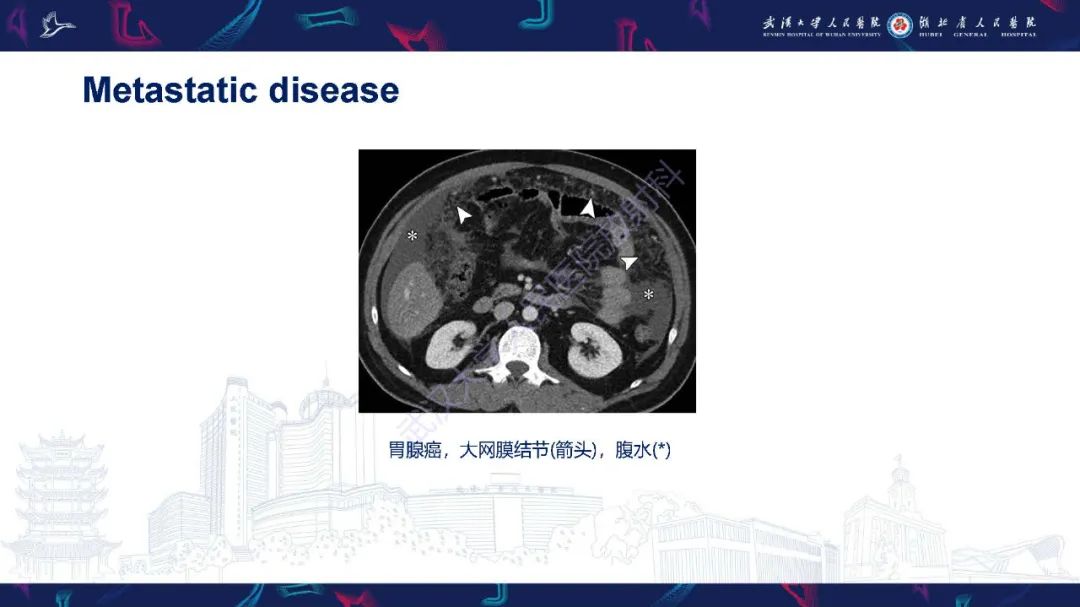影像PPT - 【PPT】胃癌淋巴引流及TNM分期-40