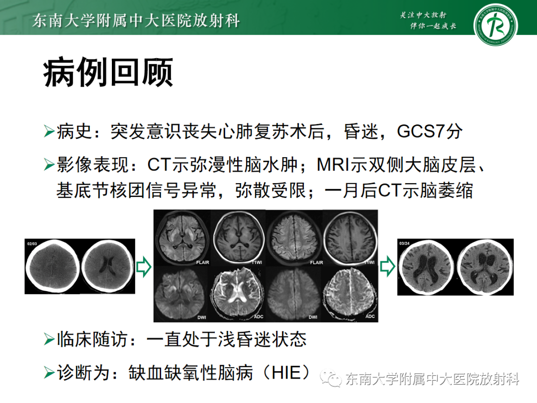 影像PPT - 【PPT】成人缺血缺氧性脑病(HIE)-1 影像PPT - 【PPT】成人缺血缺氧性脑病(HIE)-1