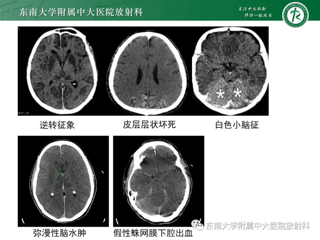影像PPT - 【PPT】成人缺血缺氧性脑病(HIE)-9 影像PPT - 【PPT】成人缺血缺氧性脑病(HIE)-9
