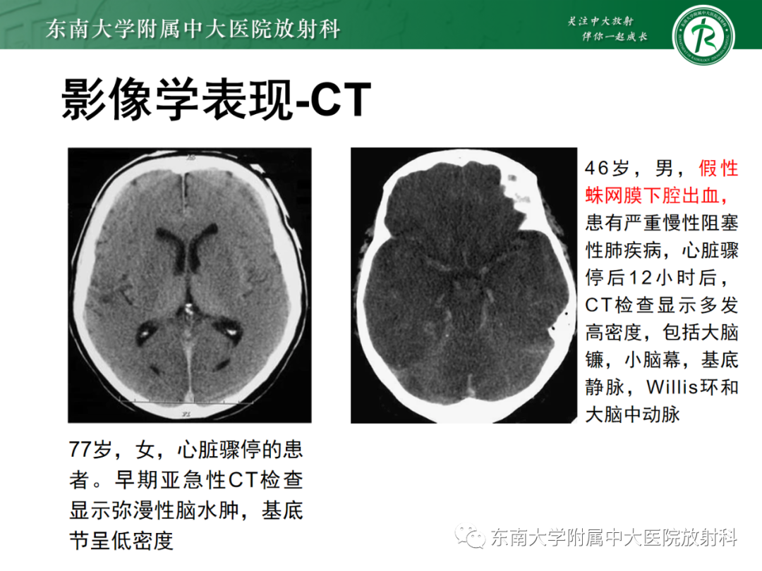 影像PPT - 【PPT】成人缺血缺氧性脑病(HIE)-10 影像PPT - 【PPT】成人缺血缺氧性脑病(HIE)-10