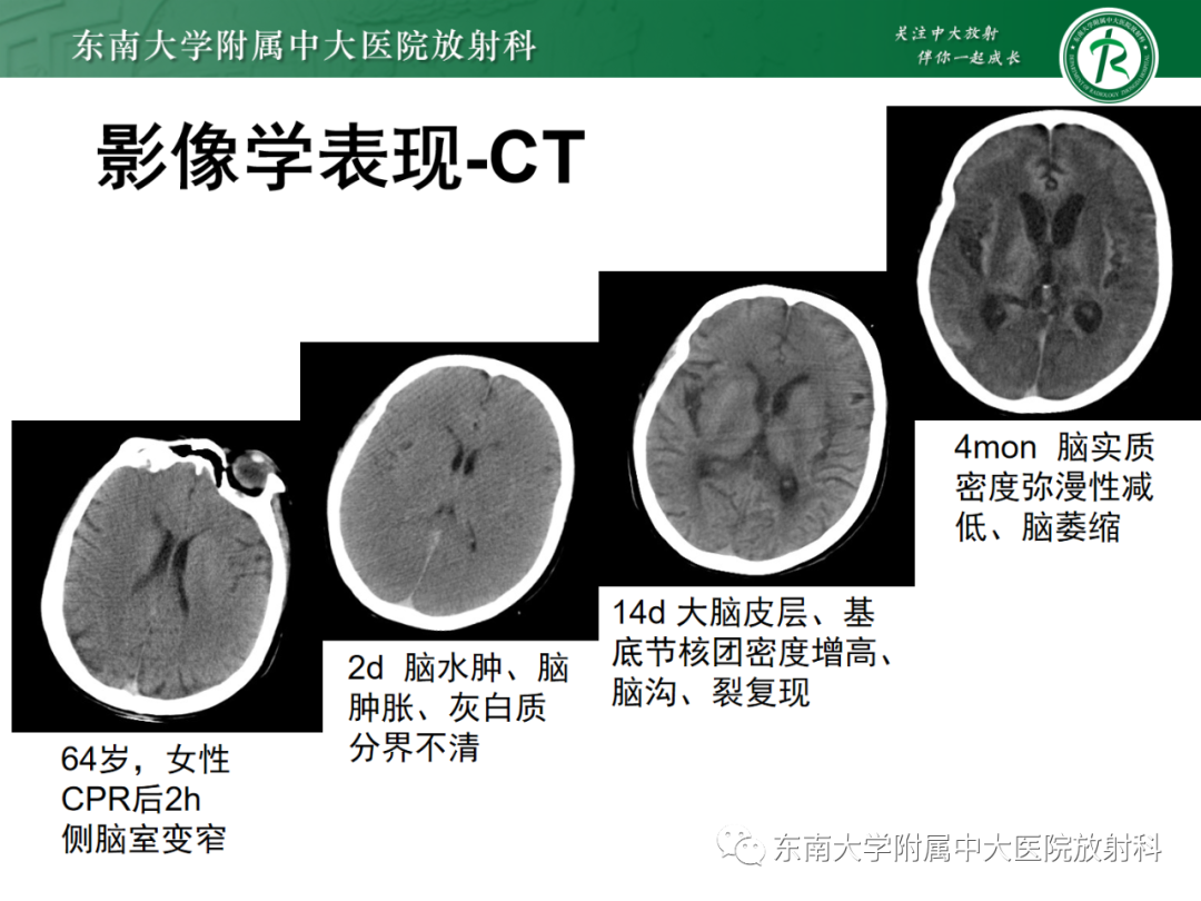 影像PPT - 【PPT】成人缺血缺氧性脑病(HIE)-11 影像PPT - 【PPT】成人缺血缺氧性脑病(HIE)-11