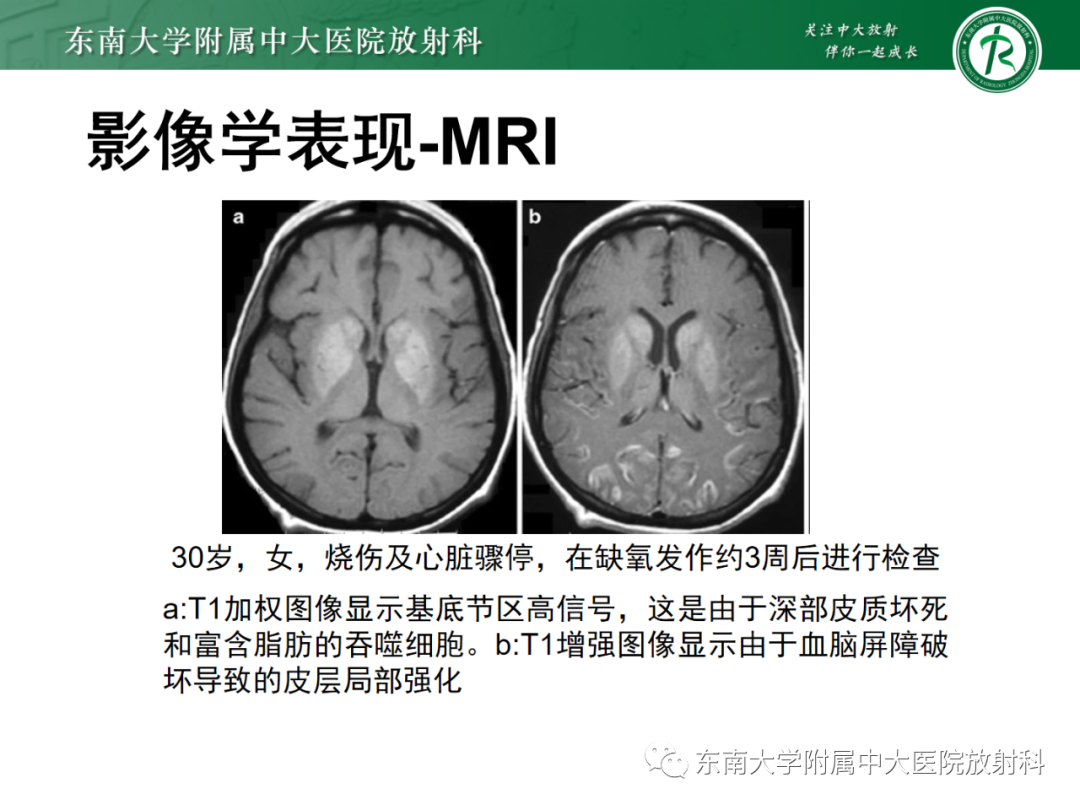 影像PPT - 【PPT】成人缺血缺氧性脑病(HIE)-14 影像PPT - 【PPT】成人缺血缺氧性脑病(HIE)-14