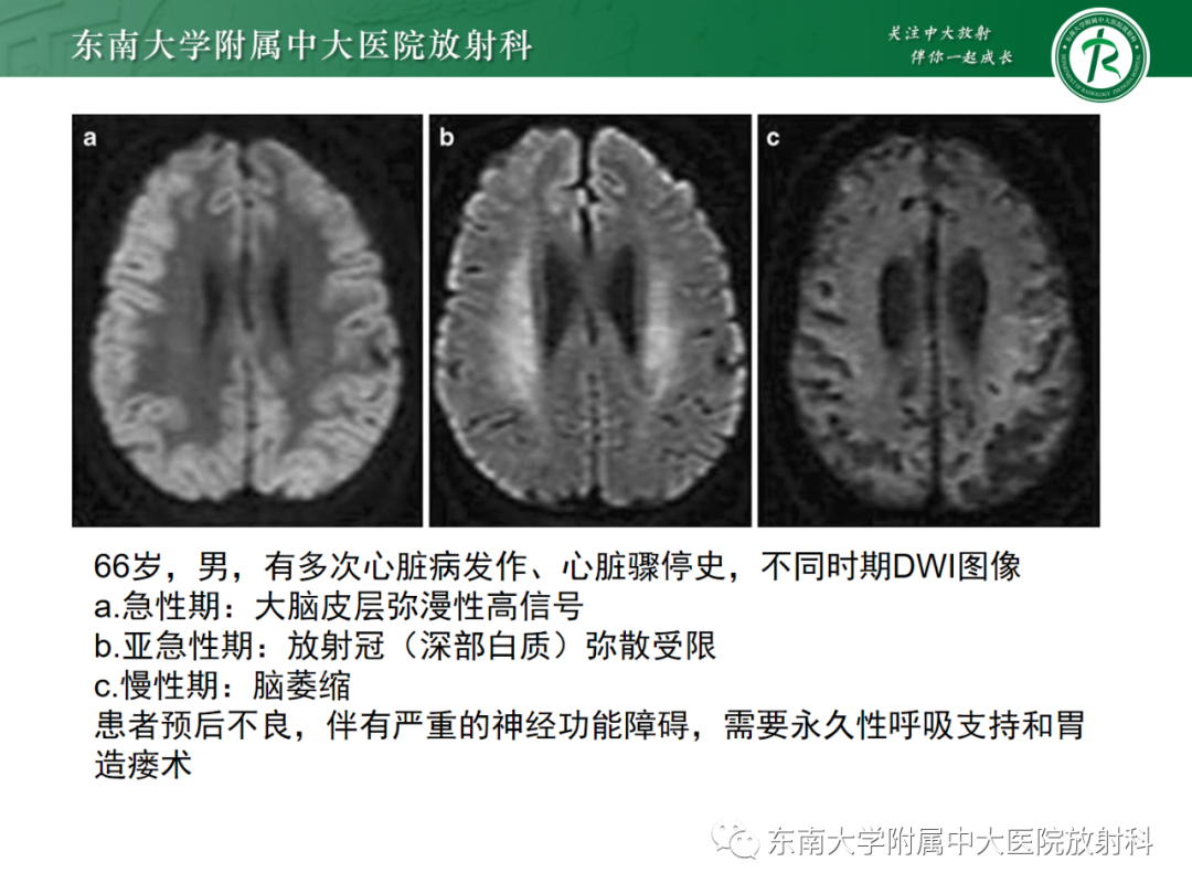 影像PPT - 【PPT】成人缺血缺氧性脑病(HIE)-15 影像PPT - 【PPT】成人缺血缺氧性脑病(HIE)-15