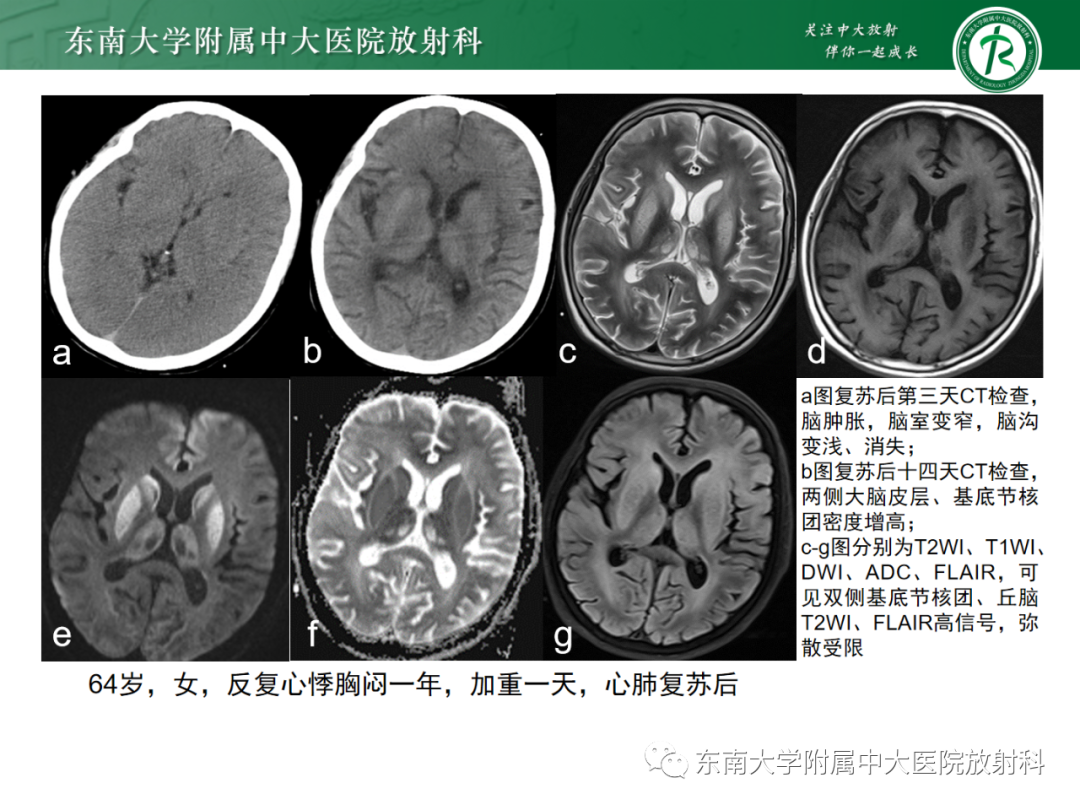 影像PPT - 【PPT】成人缺血缺氧性脑病(HIE)-16 影像PPT - 【PPT】成人缺血缺氧性脑病(HIE)-16