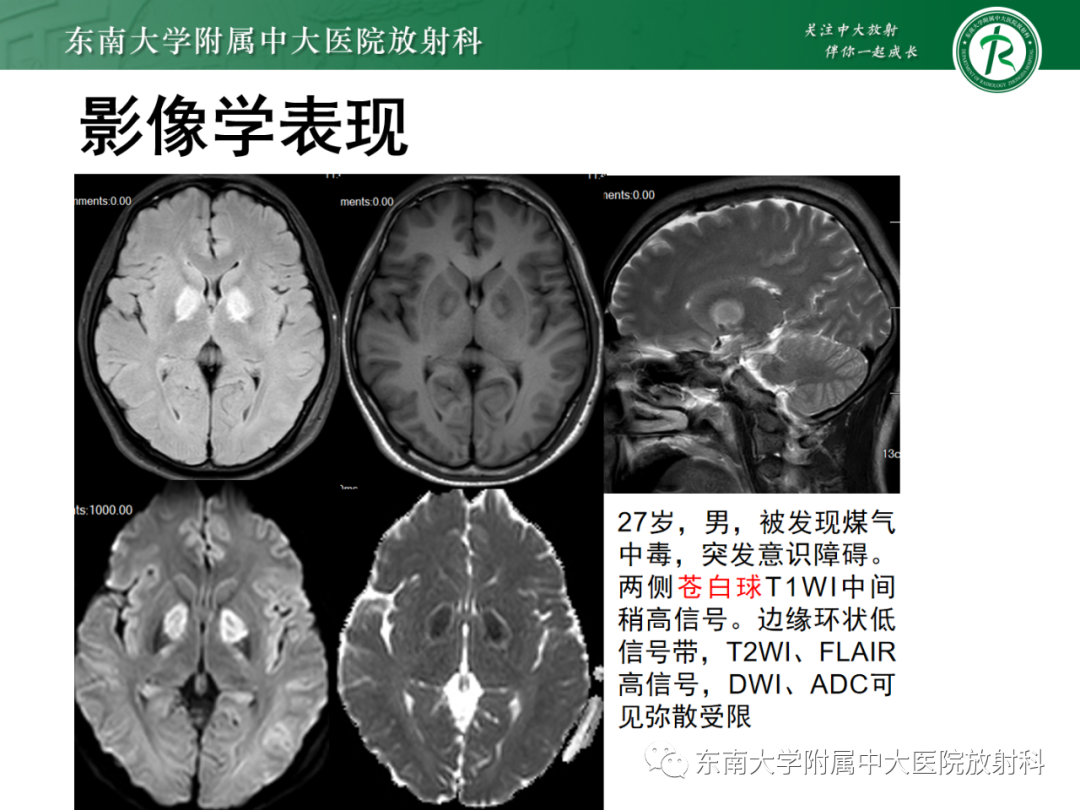 影像PPT - 【PPT】成人缺血缺氧性脑病(HIE)-19 影像PPT - 【PPT】成人缺血缺氧性脑病(HIE)-19