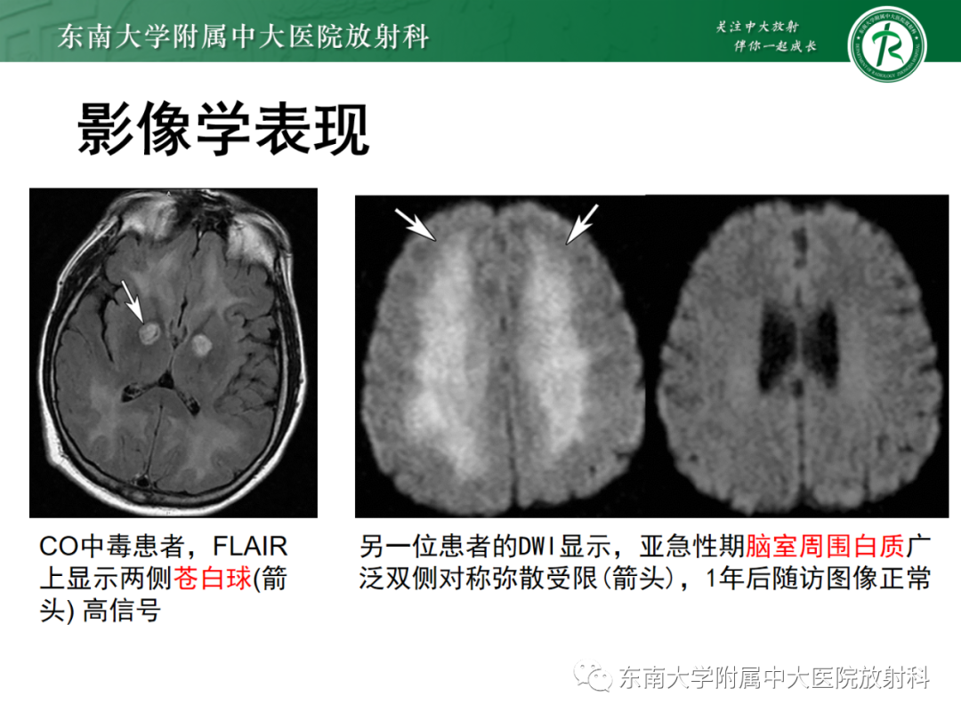 影像PPT - 【PPT】成人缺血缺氧性脑病(HIE)-20 影像PPT - 【PPT】成人缺血缺氧性脑病(HIE)-20