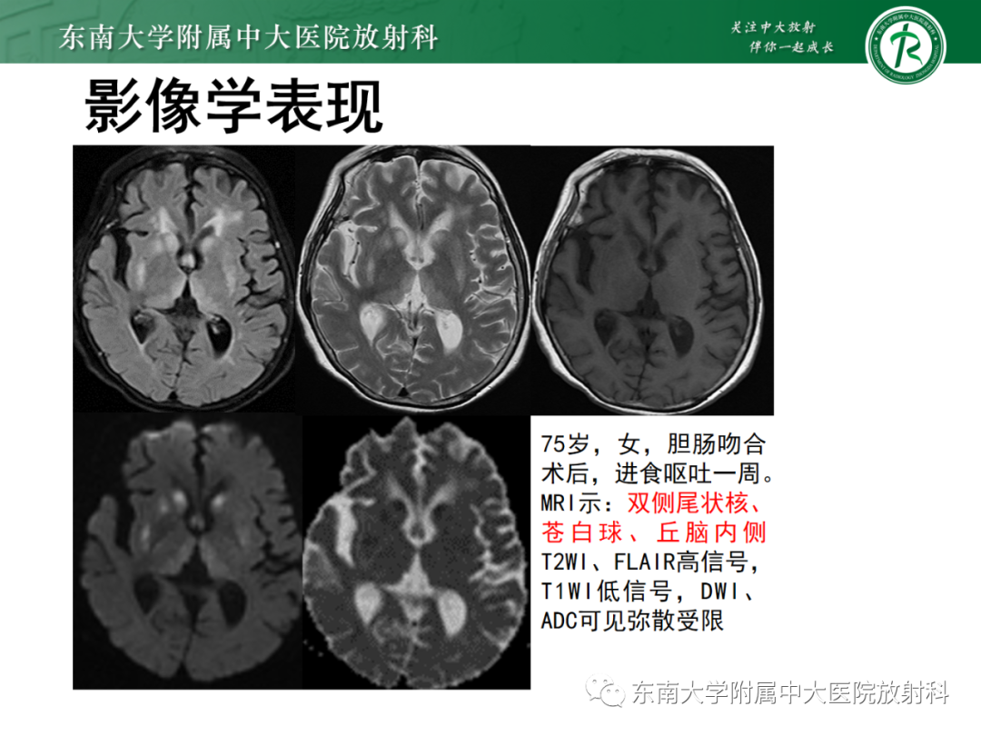 影像PPT - 【PPT】成人缺血缺氧性脑病(HIE)-22 影像PPT - 【PPT】成人缺血缺氧性脑病(HIE)-22