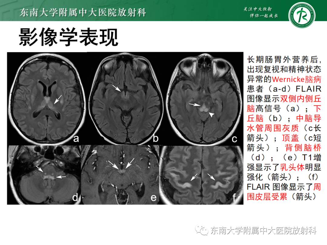 影像PPT - 【PPT】成人缺血缺氧性脑病(HIE)-23 影像PPT - 【PPT】成人缺血缺氧性脑病(HIE)-23