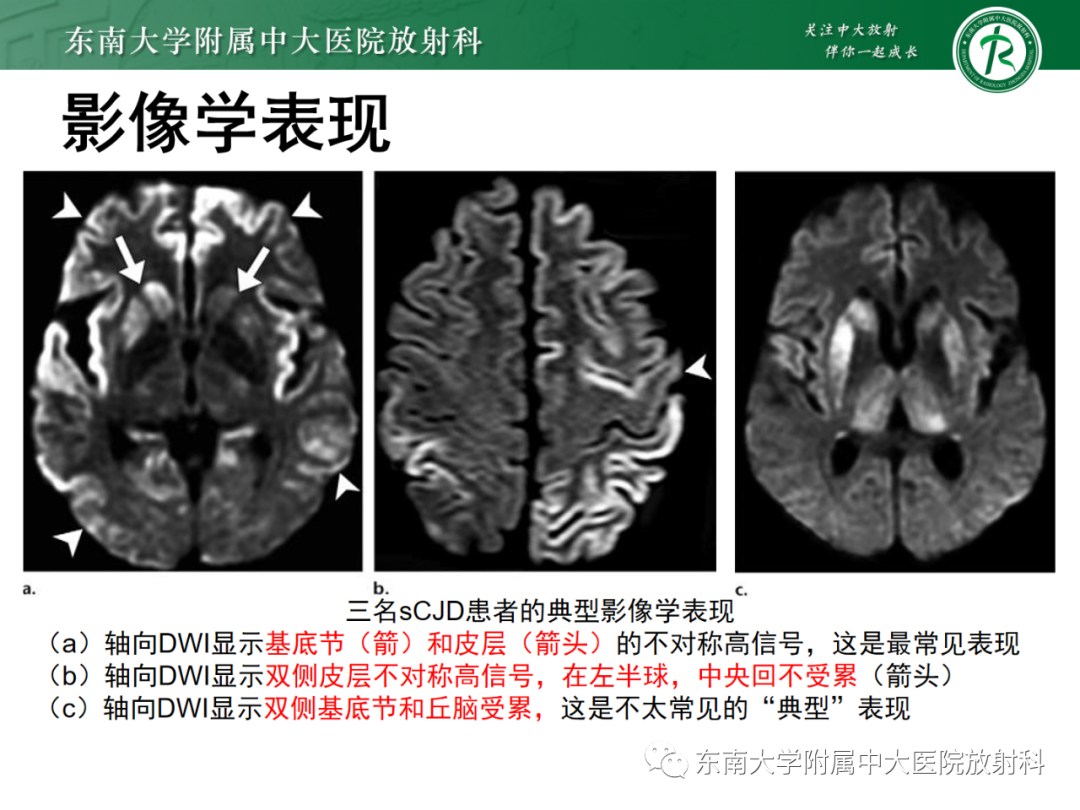 影像PPT - 【PPT】成人缺血缺氧性脑病(HIE)-25 影像PPT - 【PPT】成人缺血缺氧性脑病(HIE)-25