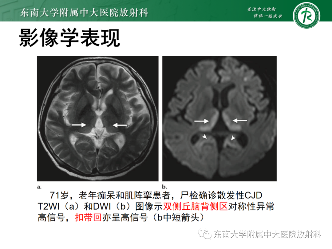 影像PPT - 【PPT】成人缺血缺氧性脑病(HIE)-26 影像PPT - 【PPT】成人缺血缺氧性脑病(HIE)-26