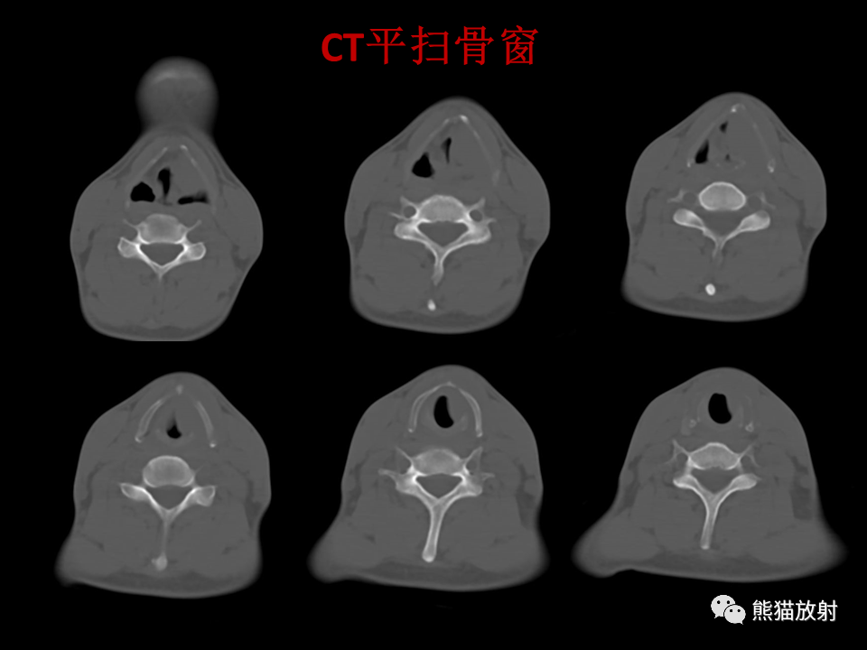 影像PPT - 【病例】喉部髓系肉瘤 VS 喉癌(鳞状细胞癌)-4