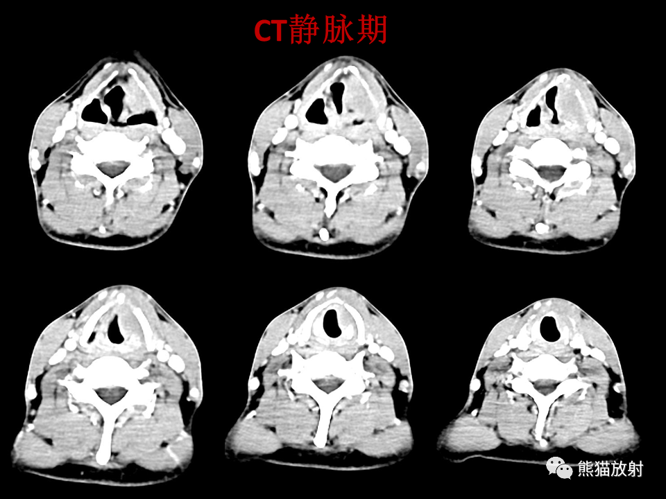 影像PPT - 【病例】喉部髓系肉瘤 VS 喉癌(鳞状细胞癌)-6