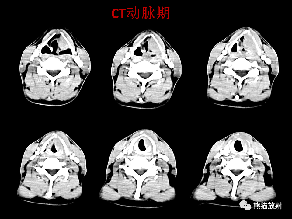影像PPT - 【病例】喉部髓系肉瘤 VS 喉癌(鳞状细胞癌)-5