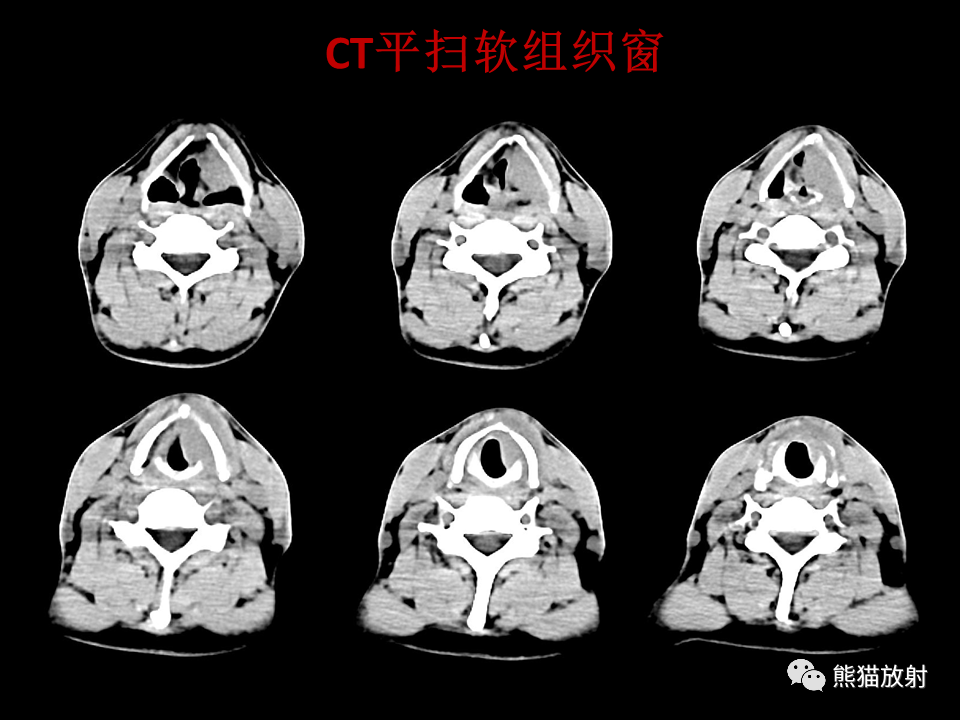 影像PPT - 【病例】喉部髓系肉瘤 VS 喉癌(鳞状细胞癌)-3