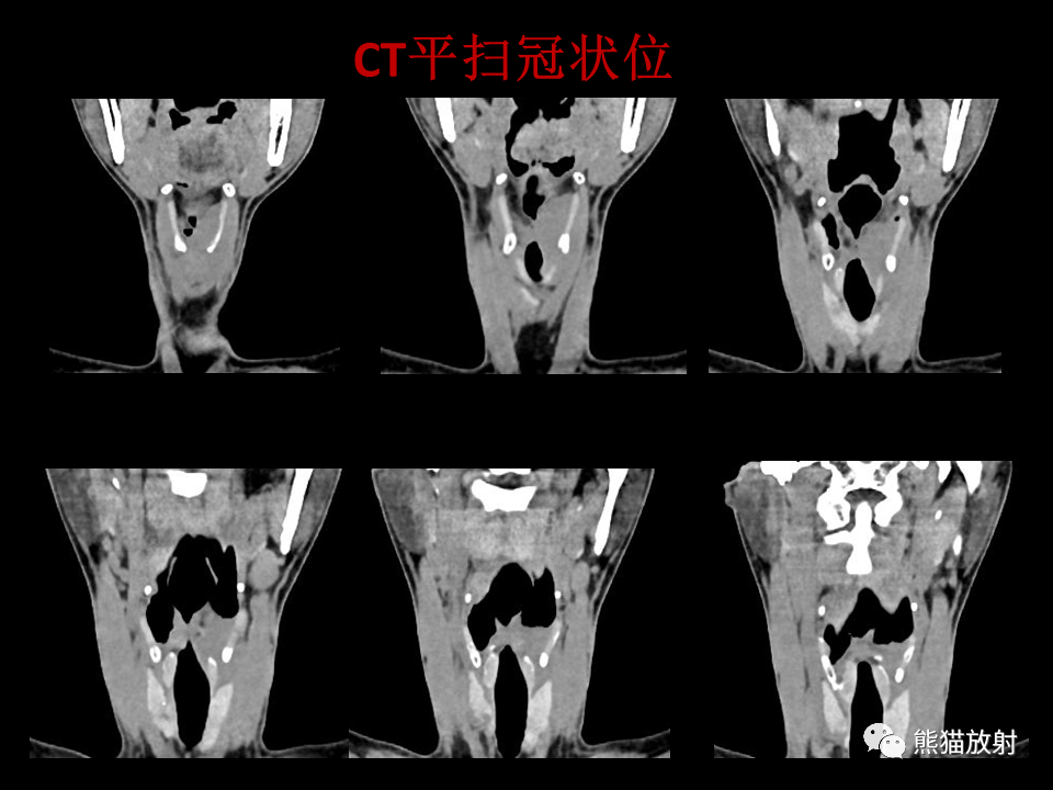 影像PPT - 【病例】喉部髓系肉瘤 VS 喉癌(鳞状细胞癌)-7