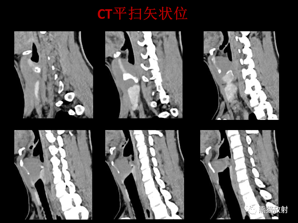 影像PPT - 【病例】喉部髓系肉瘤 VS 喉癌(鳞状细胞癌)-8