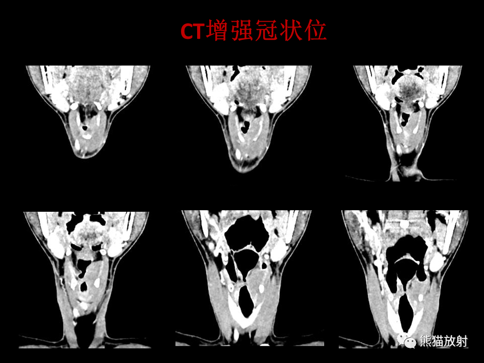 影像PPT - 【病例】喉部髓系肉瘤 VS 喉癌(鳞状细胞癌)-9