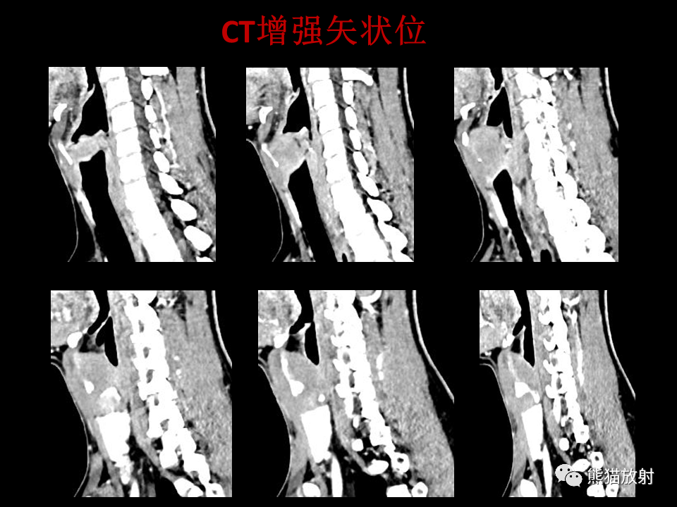 影像PPT - 【病例】喉部髓系肉瘤 VS 喉癌(鳞状细胞癌)-10