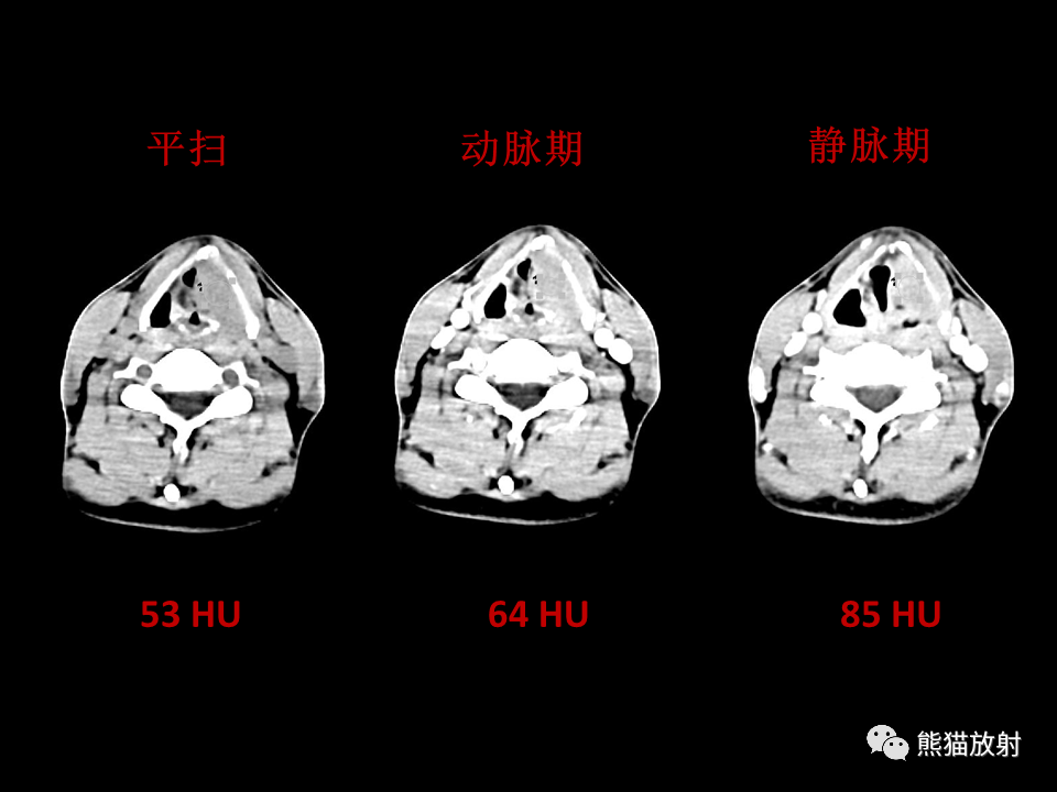 影像PPT - 【病例】喉部髓系肉瘤 VS 喉癌(鳞状细胞癌)-11