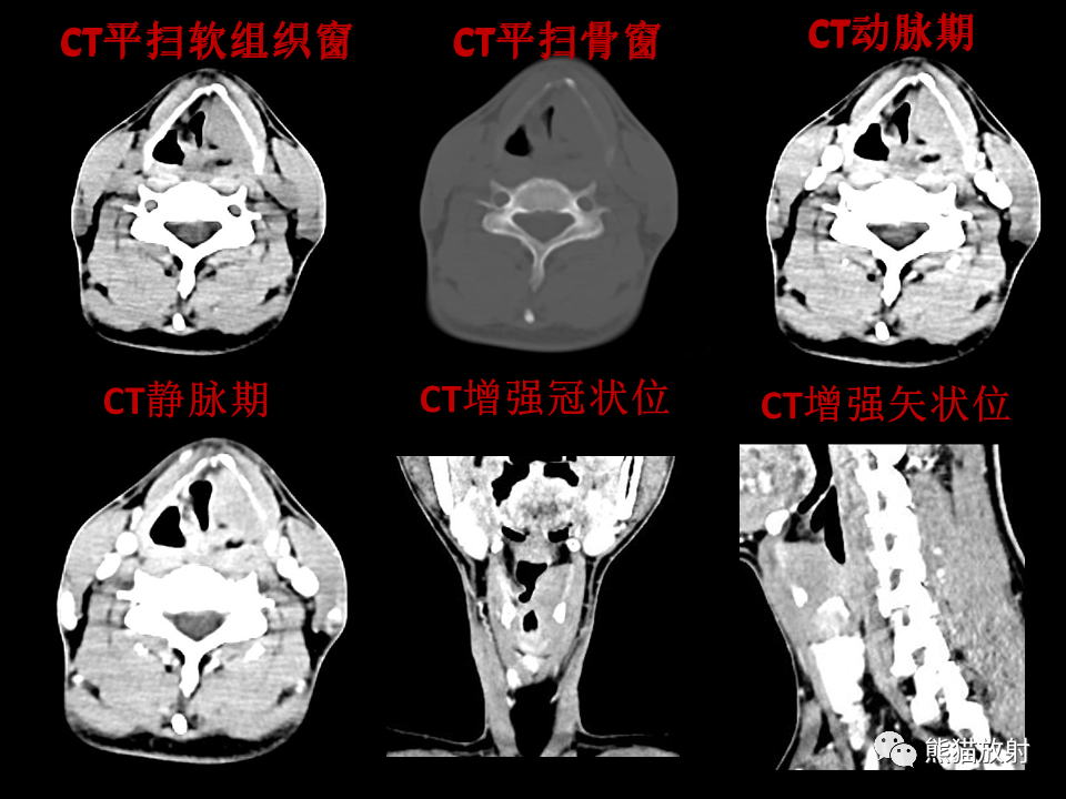 影像PPT - 【病例】喉部髓系肉瘤 VS 喉癌(鳞状细胞癌)-12