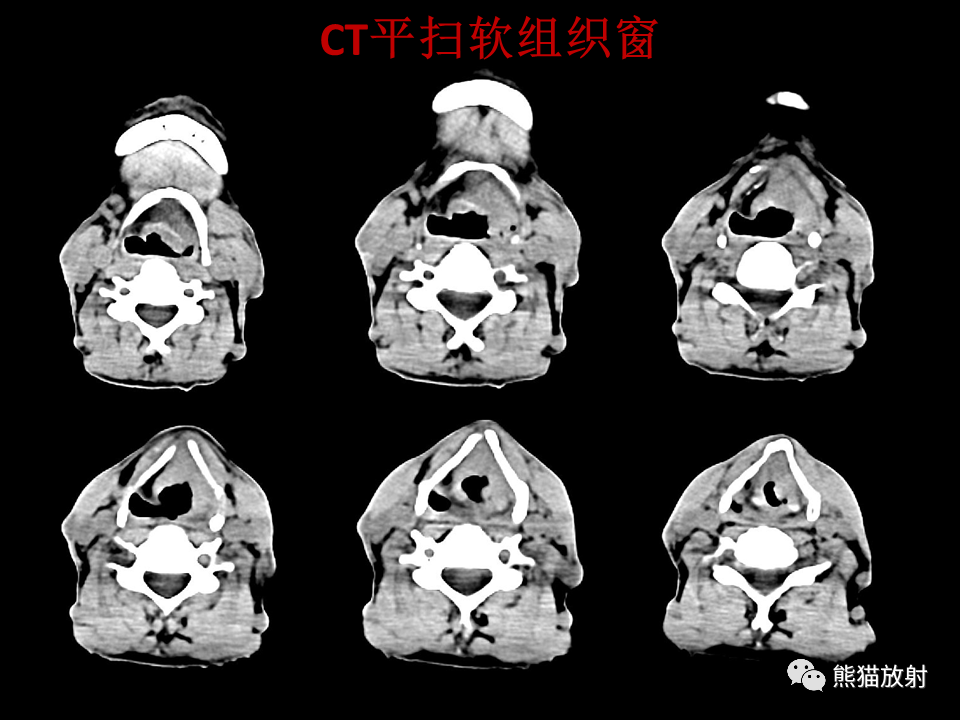 影像PPT - 【病例】喉部髓系肉瘤 VS 喉癌(鳞状细胞癌)-15