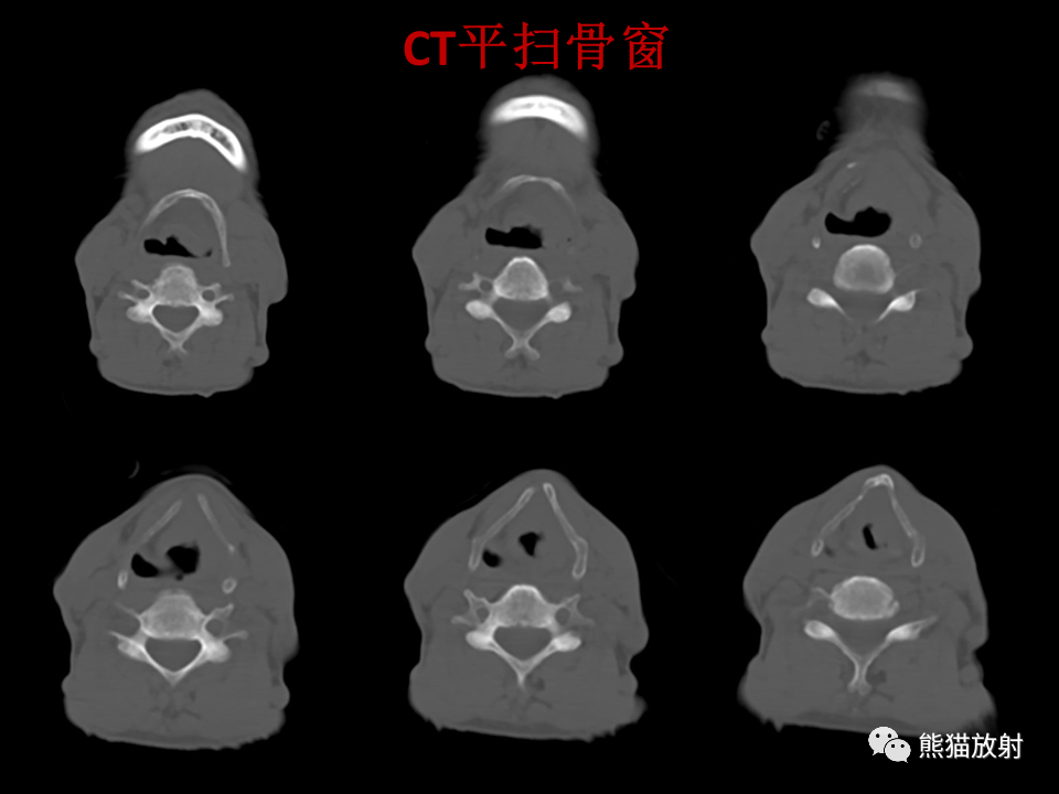 影像PPT - 【病例】喉部髓系肉瘤 VS 喉癌(鳞状细胞癌)-16