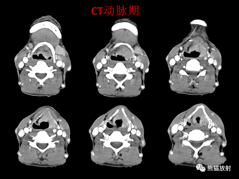影像PPT - 【病例】喉部髓系肉瘤 VS 喉癌(鳞状细胞癌)-17