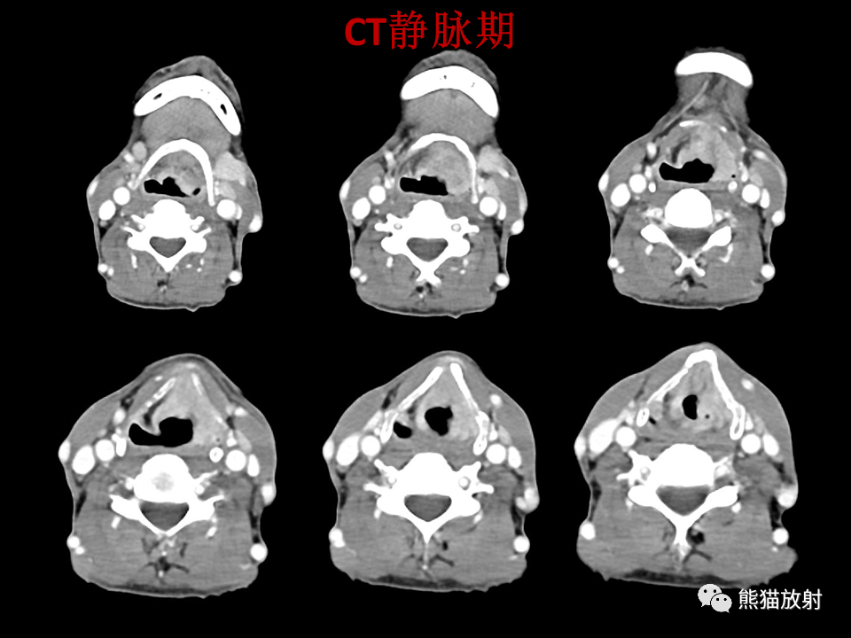 影像PPT - 【病例】喉部髓系肉瘤 VS 喉癌(鳞状细胞癌)-18