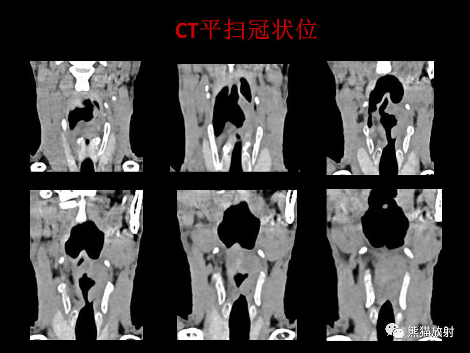 影像PPT - 【病例】喉部髓系肉瘤 VS 喉癌(鳞状细胞癌)-19