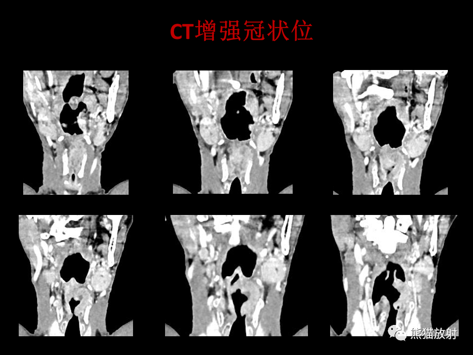 影像PPT - 【病例】喉部髓系肉瘤 VS 喉癌(鳞状细胞癌)-21
