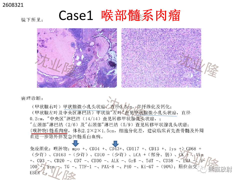 影像PPT - 【病例】喉部髓系肉瘤 VS 喉癌(鳞状细胞癌)-26