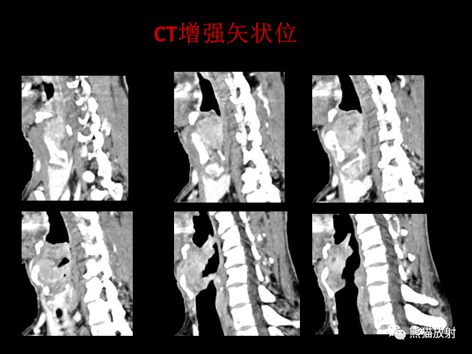 影像PPT - 【病例】喉部髓系肉瘤 VS 喉癌(鳞状细胞癌)-22