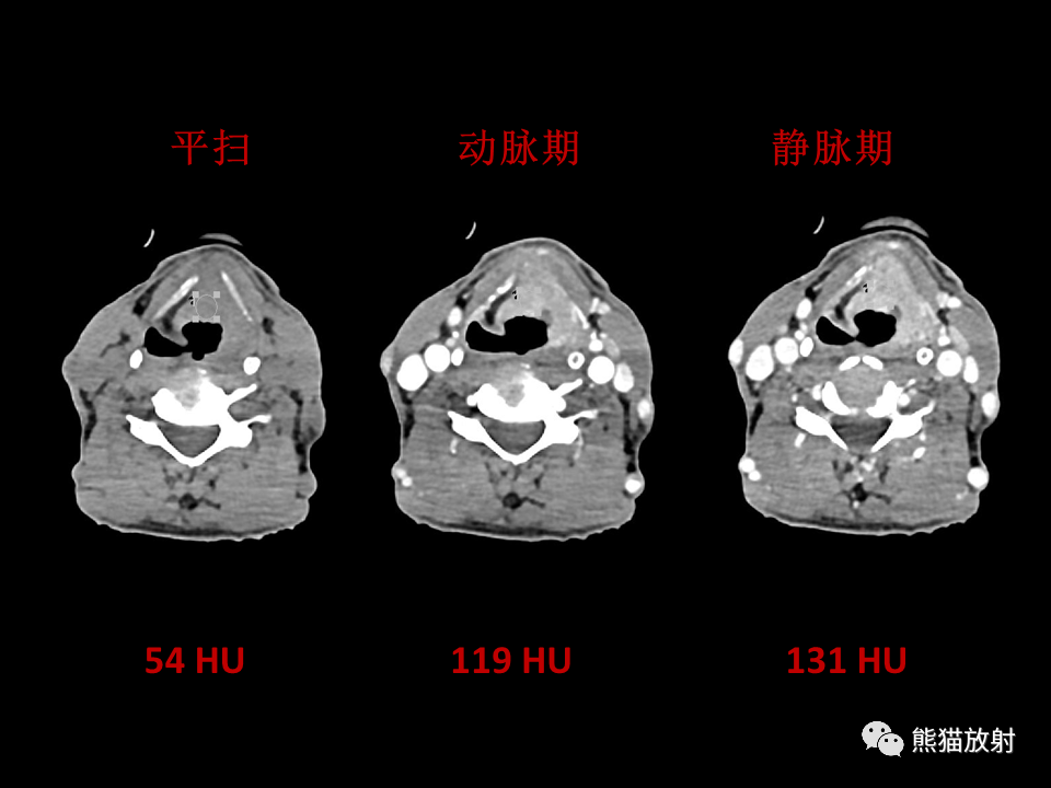 影像PPT - 【病例】喉部髓系肉瘤 VS 喉癌(鳞状细胞癌)-23