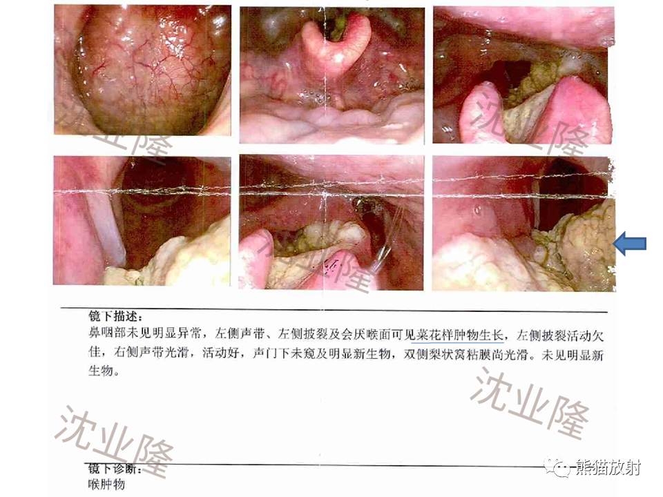 影像PPT - 【病例】喉部髓系肉瘤 VS 喉癌(鳞状细胞癌)-29