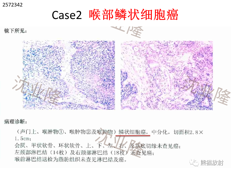影像PPT - 【病例】喉部髓系肉瘤 VS 喉癌(鳞状细胞癌)-28