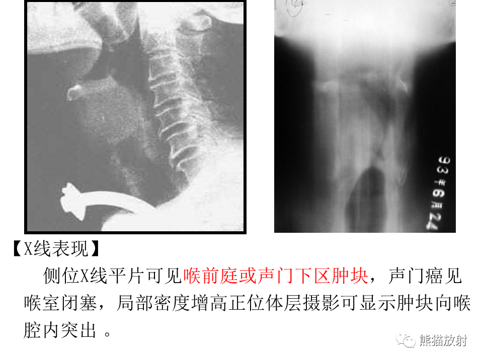 影像PPT - 【病例】喉部髓系肉瘤 VS 喉癌(鳞状细胞癌)-37