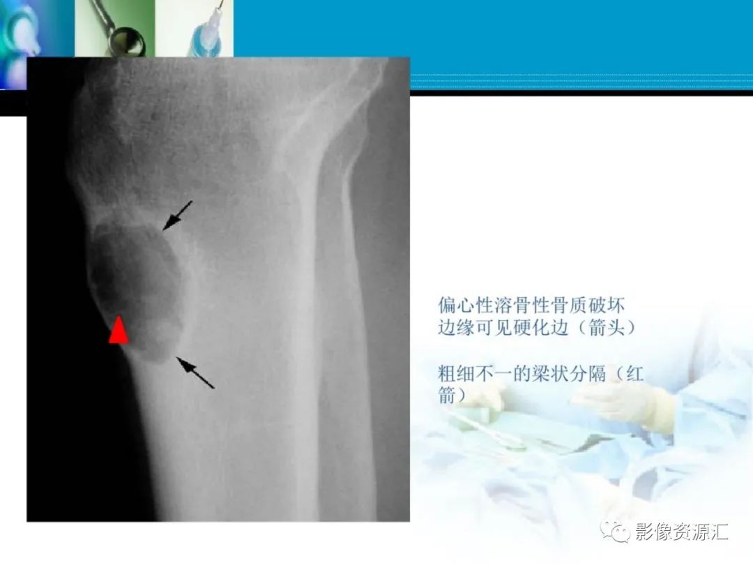 影像PPT - 【PPT】软骨粘液纤维性瘤-7