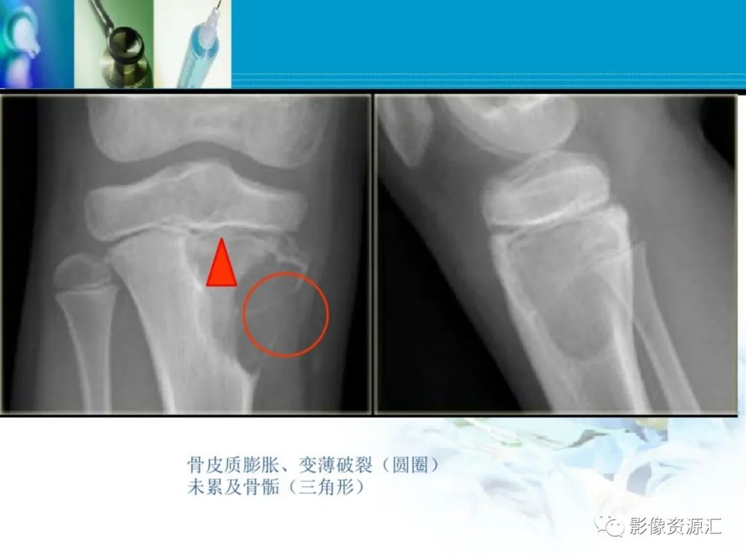 影像PPT - 【PPT】软骨粘液纤维性瘤-9