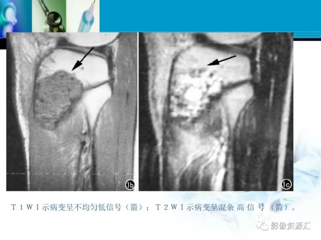 影像PPT - 【PPT】软骨粘液纤维性瘤-11