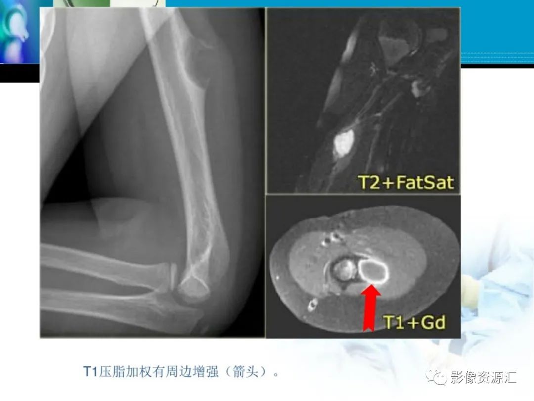 影像PPT - 【PPT】软骨粘液纤维性瘤-12