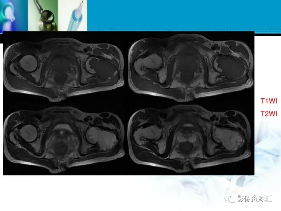 影像PPT - 【PPT】软骨粘液纤维性瘤-15