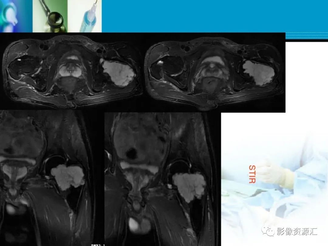 影像PPT - 【PPT】软骨粘液纤维性瘤-16