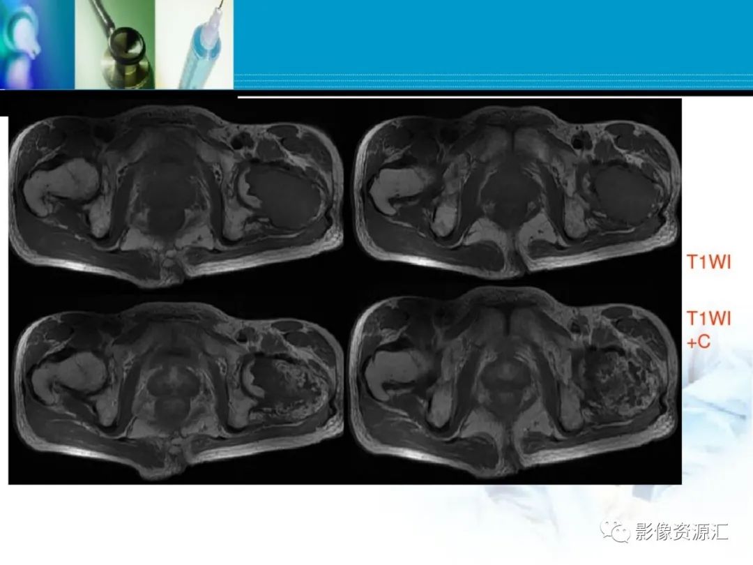 影像PPT - 【PPT】软骨粘液纤维性瘤-17