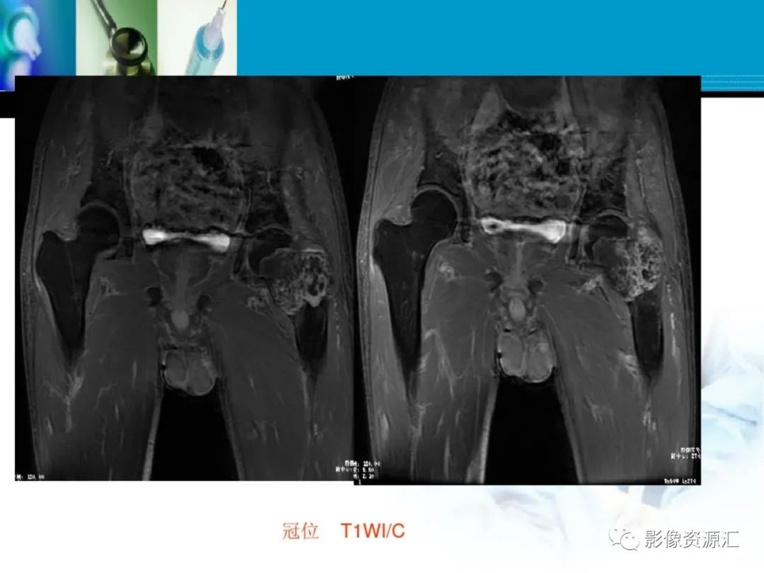影像PPT - 【PPT】软骨粘液纤维性瘤-18