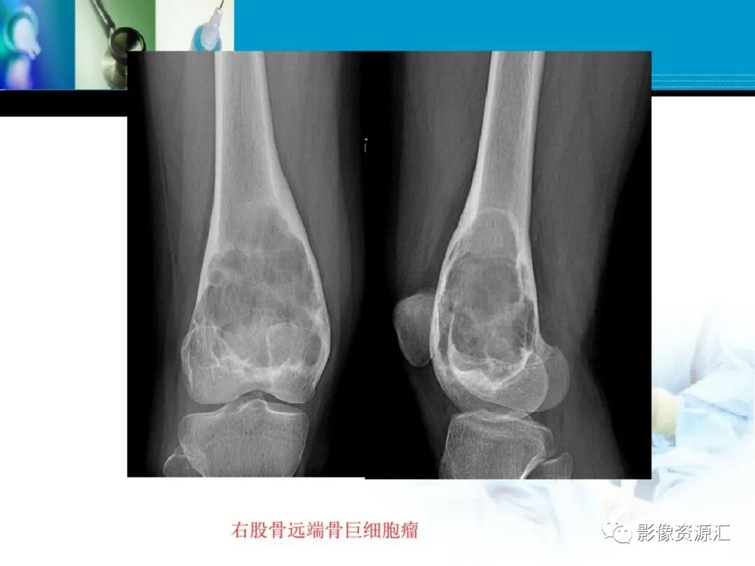 影像PPT - 【PPT】软骨粘液纤维性瘤-22