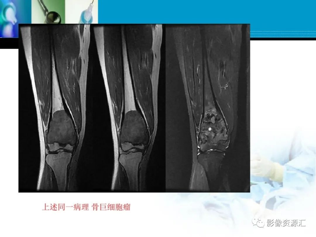 影像PPT - 【PPT】软骨粘液纤维性瘤-23