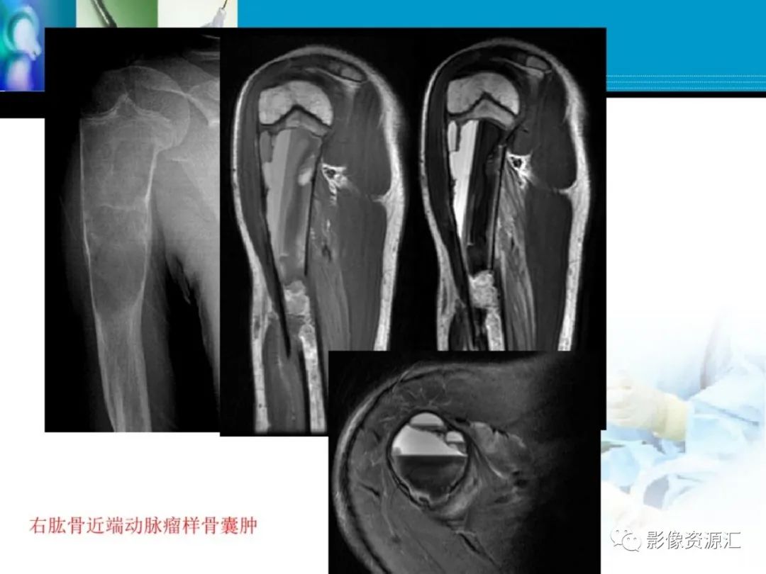 影像PPT - 【PPT】软骨粘液纤维性瘤-25